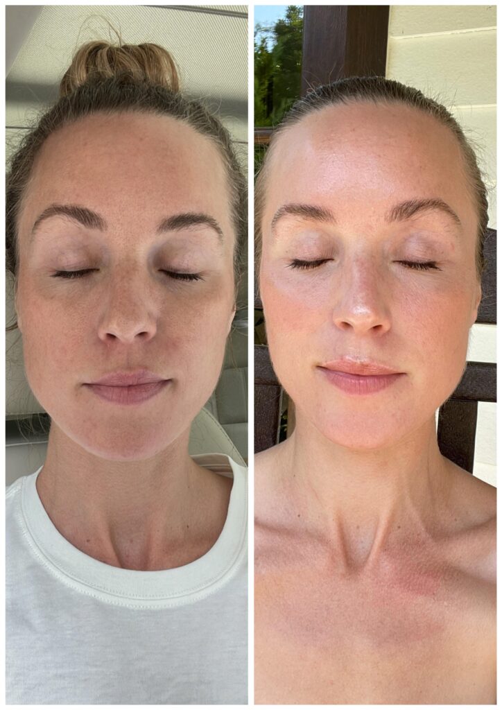 My MOXI Laser Treatment Review with Before & Afters – Natalie Yerger